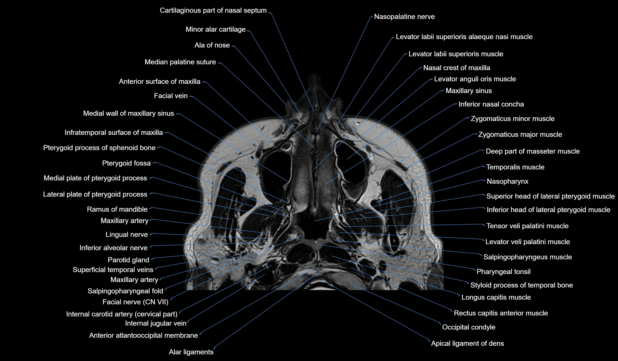 MRI face & paranasal sinuses(PNS) labelled  coronal  cross sectional anatomy 3T radiology  image-img-00001-00006.webp